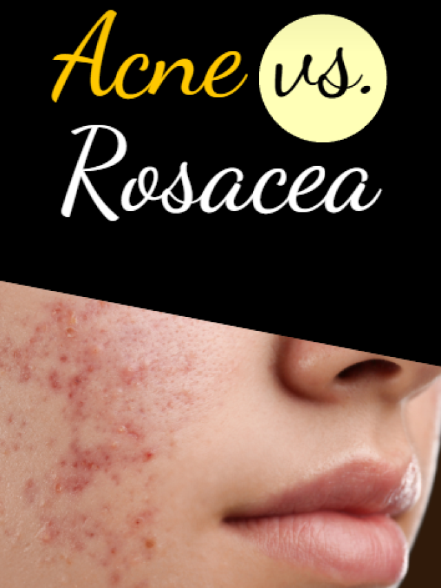 Acne vs. Rosacea