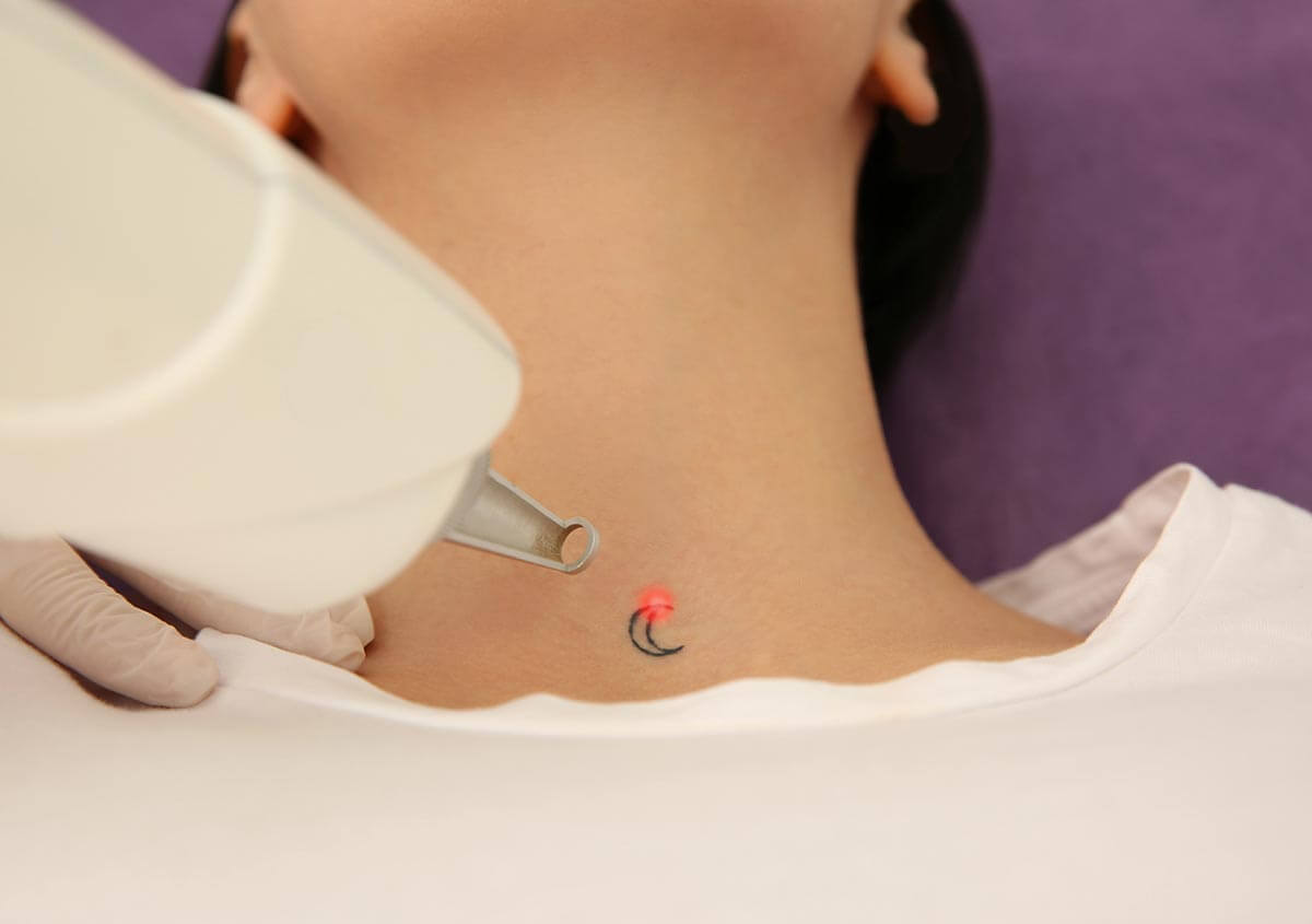 Picoway Laser Treatment in Orlando FL Area