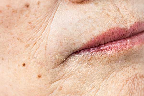 Age spots