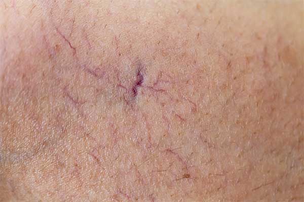 Capillaries