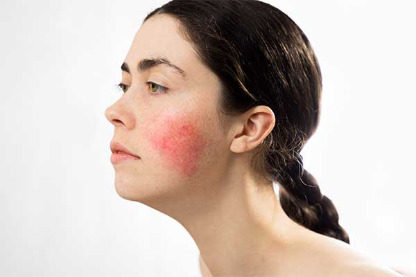Rosacea on woman face
