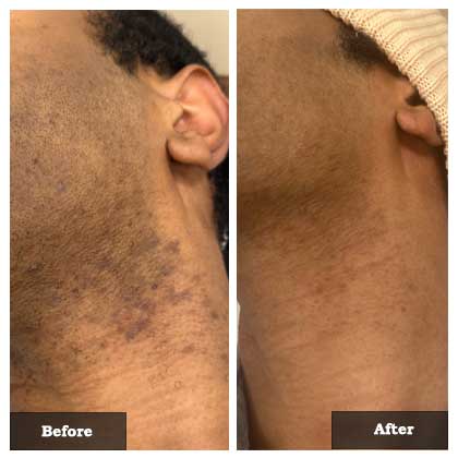 Laser hair removal