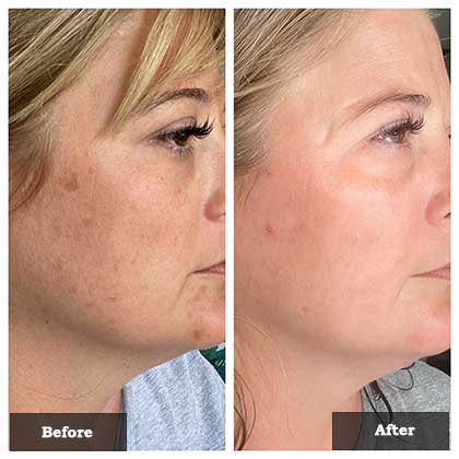 IPL treatment for face spots before and after