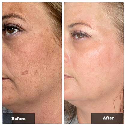 IPL treatment for remove face spots before and after