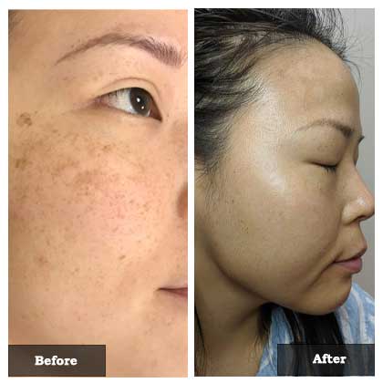 IPL treatment for remove woman's face spots before and after