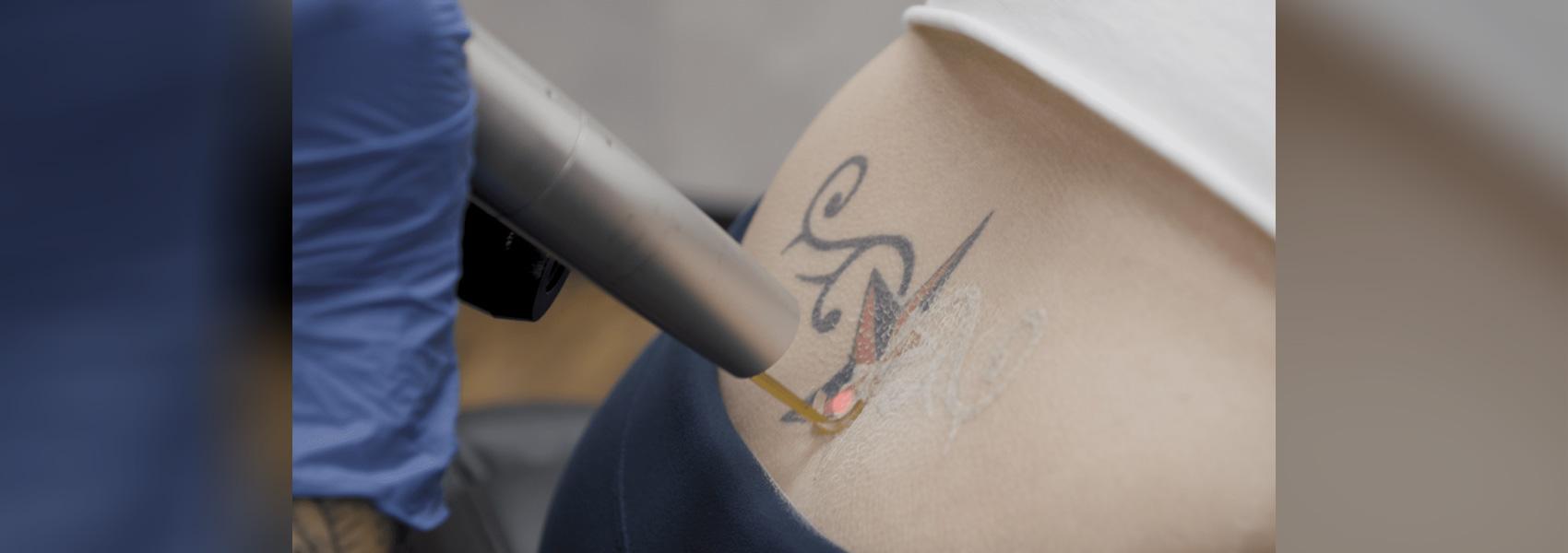 Laser Tatoo Remove - Laser Center of Orlando, FL
