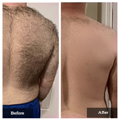 Laser Hair Removal Before and After Actual patient result case-2