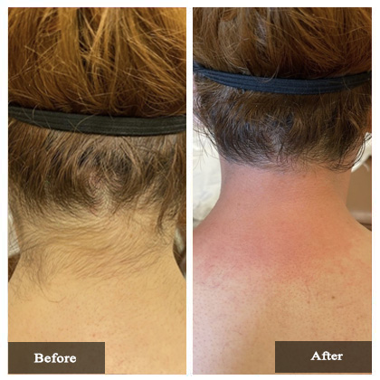 Laser Hair Removal Before and After Actual patient result case-3