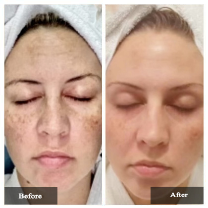 Microneedling Before and After Actual patient result case-1