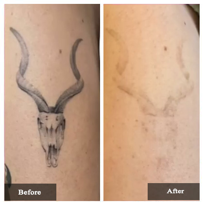 Tattoo removal Before and After Actual patient result case-2