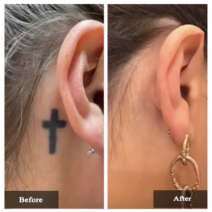 Tattoo removal Before and After Actual patient result case-3