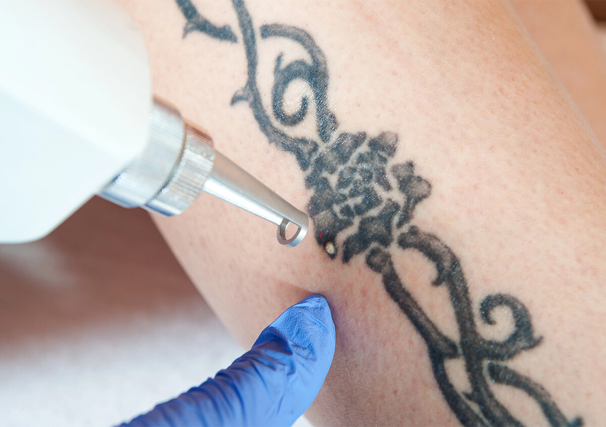 Tattoo Laser Removal in Orlando FL Area