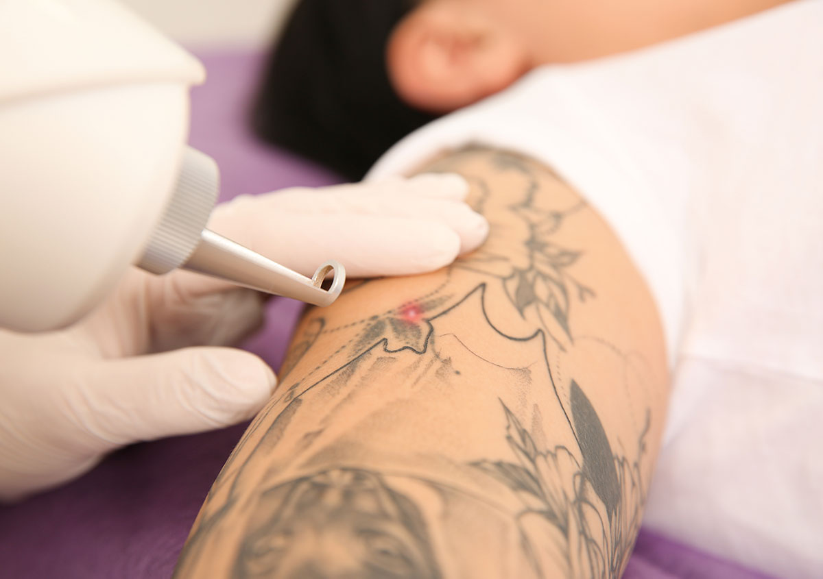 Professional Tattoo Removal in Orlando FL area