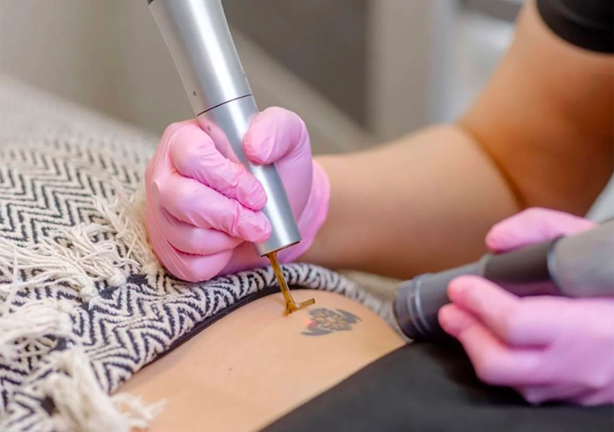 Professional Laser Tattoo Removal in Orlando FL Area