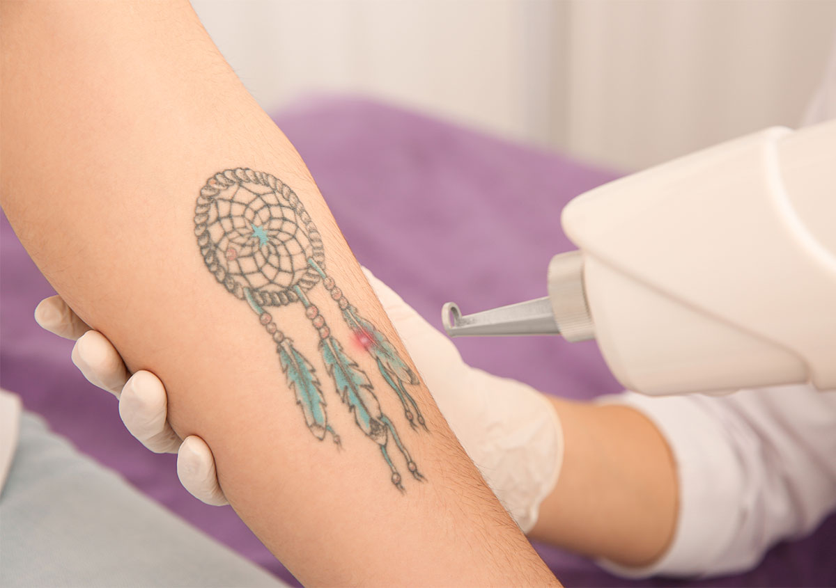 Most Effective Laser for Tattoo Removal in Orlando FL Area